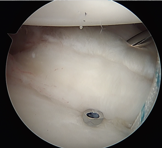 Capsular plication with suture anchors